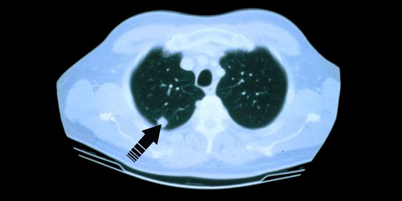 Former Smoker? 5 Reasons You Need a Lung Cancer Screening